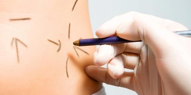 que hay de cierto en la liposuccion laser y ultrasonidos