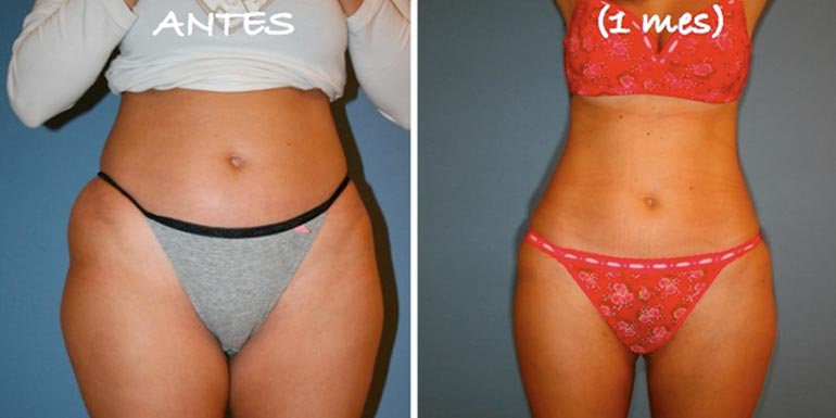 foto liposuccion madrid foto liposuccion madrid (resultados de los mejores cirujanos plasticos)