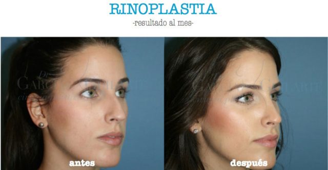 foto rinoplastia madrid mejor cirujano plastico operacion nariz