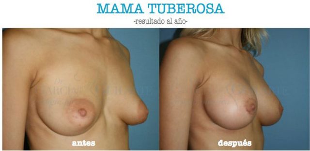 foto mama tuberosa madrid cirujano plastico dr guilarte foto mama tuberosa madrid cirujano plastico dr guilarte