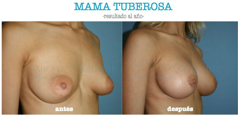 foto mama tuberosa madrid cirujano plastico dr guilarte foto mama tuberosa madrid cirujano plastico dr guilarte