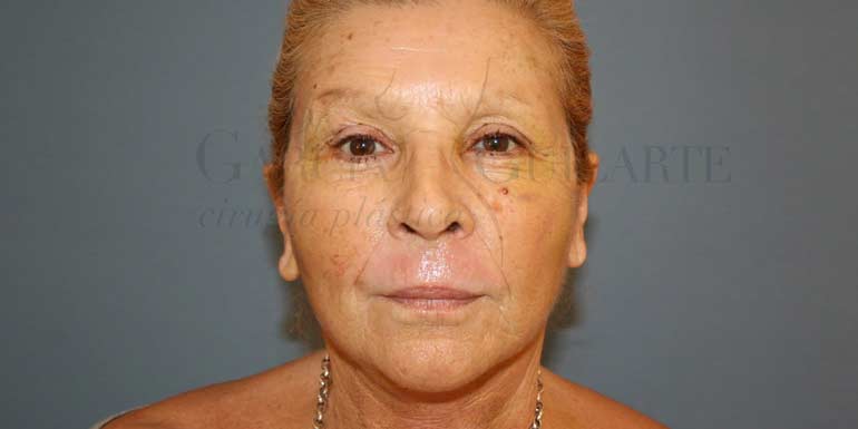 Lifting facial madrid, el mejor cirujano plastico Lifting facial madrid, el mejor cirujano plastico