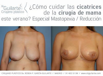 ¿Cómo cuidar las cicatrices de la cirugía de mamas este verano? Cuidado cicatrices mastopexia. Cuidado cicatrices reducción de pecho. ¿Cómo cuidar las cicatrices de la cirugía de mamas este verano? Cuidado cicatrices mastopexia. Cuidado cicatrices reducción de pecho.