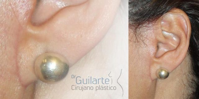lifting facial imperceptible resultados dr guilarte cirujano madrid
