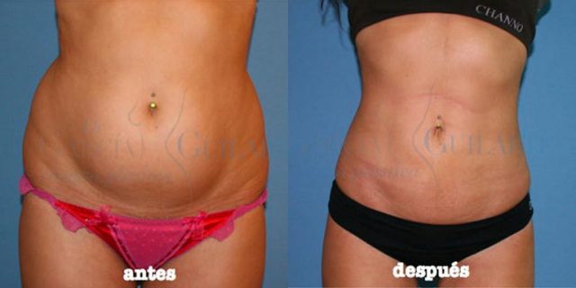 abdominoplastia o liposuccion cirugia abdomen madrid abdominoplastia o liposuccion cirugia abdomen madrid