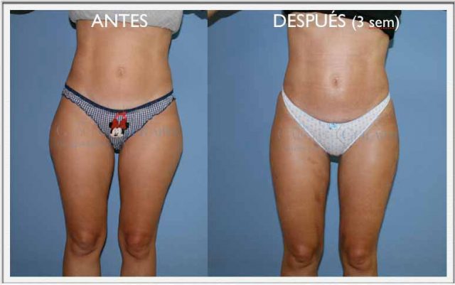 liposuccion-resultados-a-las-3-semanas-clinica-madrid-lipoescultura liposuccion-resultados-a-las-3-semanas-clinica-madrid-lipoescultura