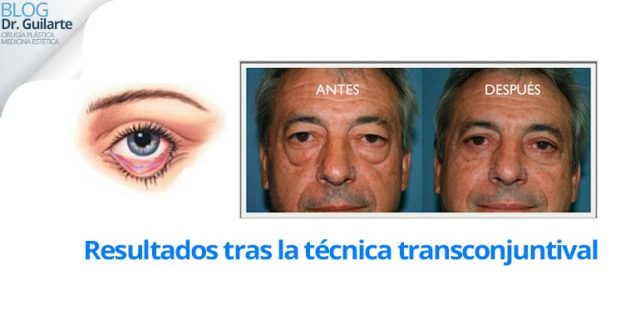 blefaroplastia transconjuntival resultados y esquema cirugia