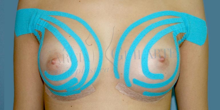 kinesiotape en aumento de pecho – kinesiotaping kinesiotape en aumento de pecho - kinesiotaping