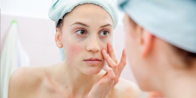 ojeras relleno con acido hialuronico como evitar la inflamacion