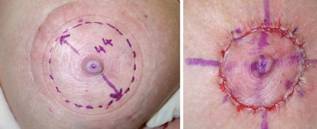 reduccion areola en mastopexia tecnica ejemplo