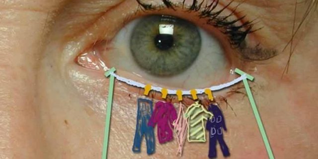 cantopexia solucion cuerda parpado inferior blefaroplastia