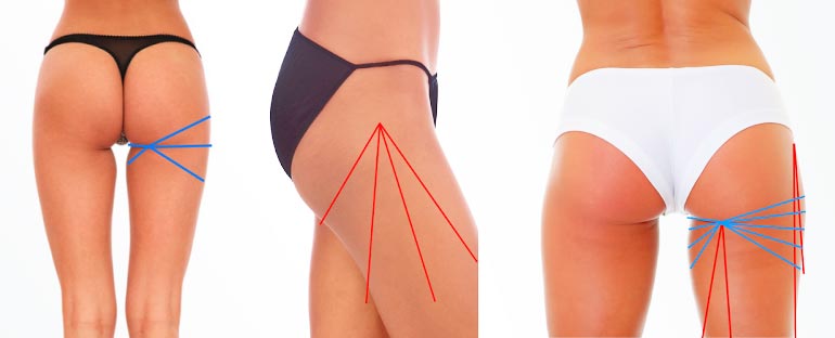 Vector vertical en liposucción Vector vertical en liposucción