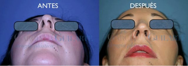 rinoplastia-desviacion-tabique-septoplastia-cirujano-plastico