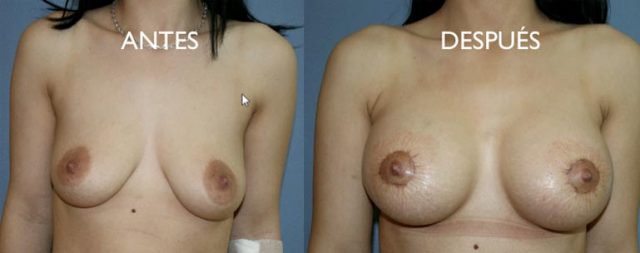 mastopexia periareolar para evitar una vertical