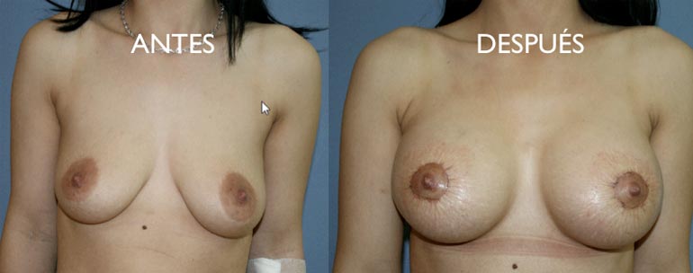 mastopexia-periareolar-para-evitar-una-vertical mastopexia periareolar para evitar una vertical