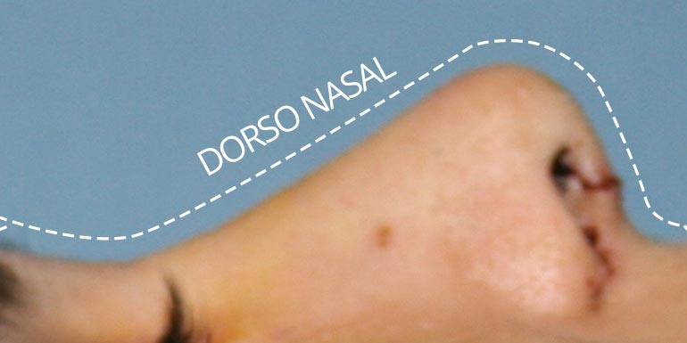 rinoplastia-reducción-tabique-dorso-nasal-cirujano-plastico