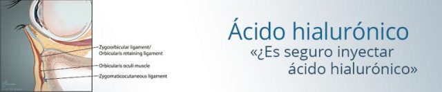 acido hialuronico es seguro inyectar hialuronico en las ojeras