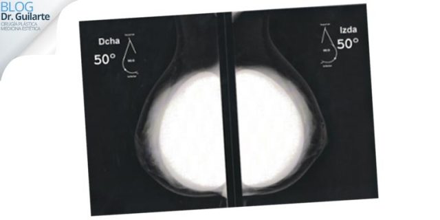 mamografia-tras-aumento-pecho-o-mastopexia-con-implantes-mamarios-y-protesis-mamarias mamografia tras aumento pecho o mastopexia con implantes mamarios y protesis mamarias