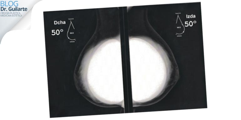 mamografia-tras-aumento-pecho-o-mastopexia-con-implantes-mamarios-y-protesis-mamarias mamografia tras aumento pecho o mastopexia con implantes mamarios y protesis mamarias