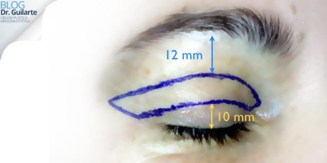 blefaroplastia madrid diseno cirugia parpados