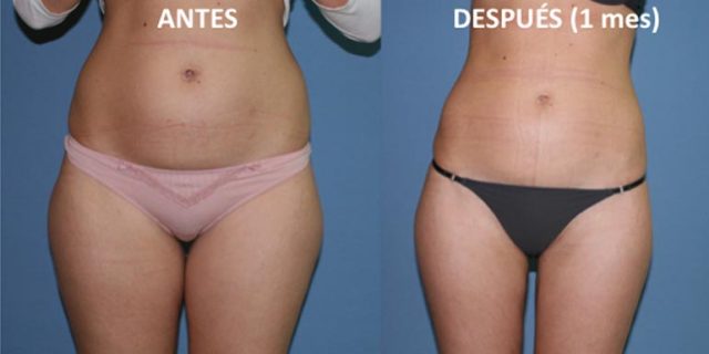 liposuccion solo cartucheras o tambien cara interna de los muslos liposuccion solo cartucheras o tambien cara interna de los muslos