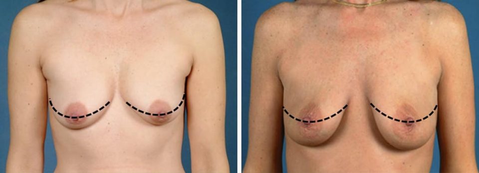 mastopexia-periareolar-o-veritcal-consulta-mejor-cirujano-plastico-madrid mastopexia periareolar o veritcal consulta mejor cirujano plastico madrid