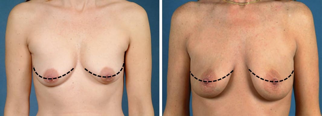 mastopexia-periareolar-o-veritcal-consulta-mejor-cirujano-plastico-madrid mastopexia periareolar o veritcal consulta mejor cirujano plastico madrid