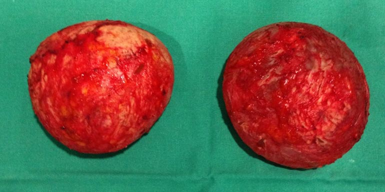 contractura-capsular-capsulectomia-cirugia-madrid contractura-capsular-capsulectomia-cirugia-madrid