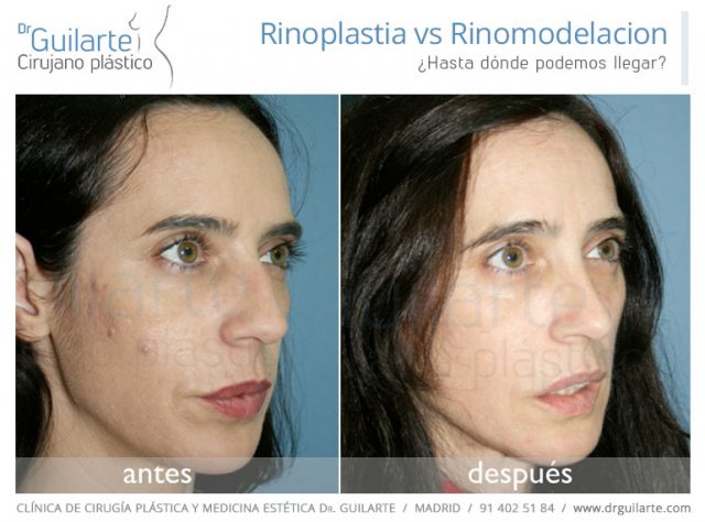 Rinoplastia Madrid vs Rinomodelación Madrid | Cirujano plástico Dr Guilarte