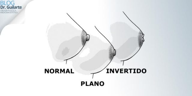 pezon-invertido-inverso-o-invaginado-blog-de-cirugia-estetica pezon-invertido-inverso-o-invaginado-blog-de-cirugia-estetica