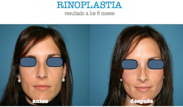 rinoplastia-fotos-casos-reales-reduccion-dorso-tabique-limado.jpg