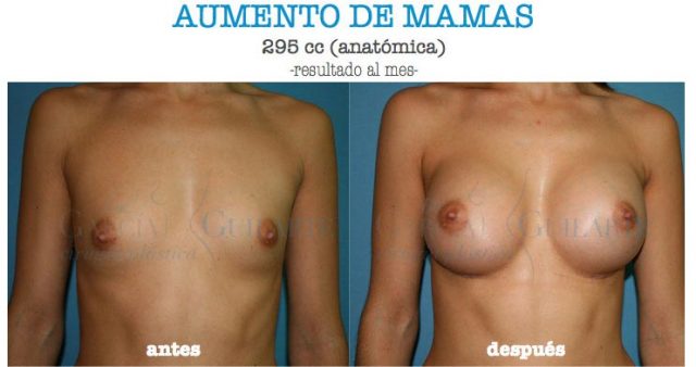 foto aumento pecho madrid mejores resultados aumento mamario foto aumento pecho madrid mejores resultados aumento mamario