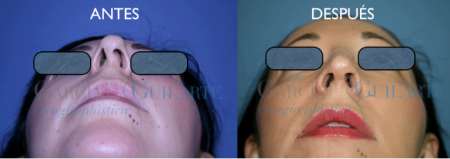 rinoplastia secundaria madrid desviacion tabique septoplastia