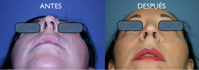 rinoplastia secundaria madrid desviacion tabique septoplastia rinoplastia secundaria madrid desviacion tabique septoplastia