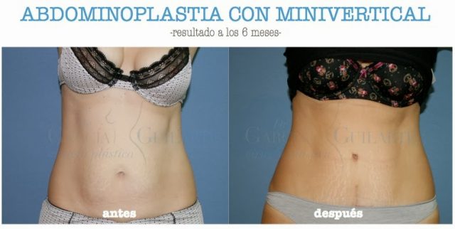 abdominoplatia-minivertical-cirujano-plastico madrid abdominoplatia minivertical cirujano plastico madrid