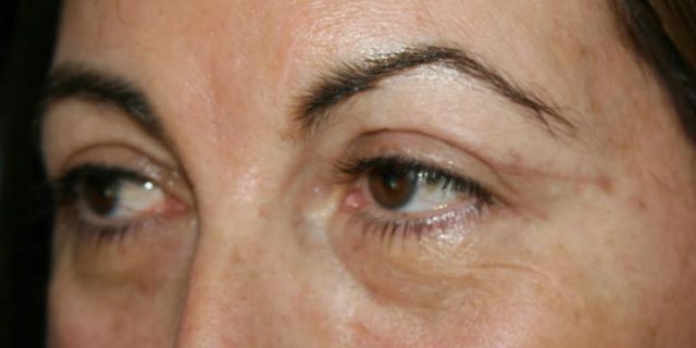 blefaroplastia-madrid-cirujano-plastico-parpados