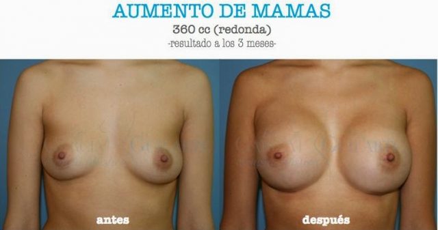 AUMENTO-DE-MAMAS.079