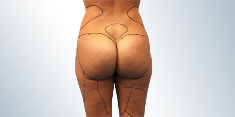liposuccion-madrid-cirujano-plastico-drguilarte