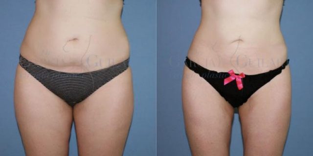 liposuccion madrid cara interna muslos-cartucheras