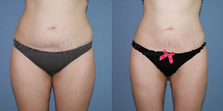 liposuccion madrid cara interna muslos-cartucheras