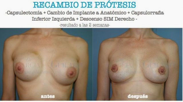 recambio_protesis_mama