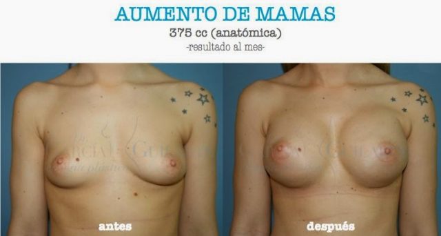 AUMENTO-DE-MAMAS.0851
