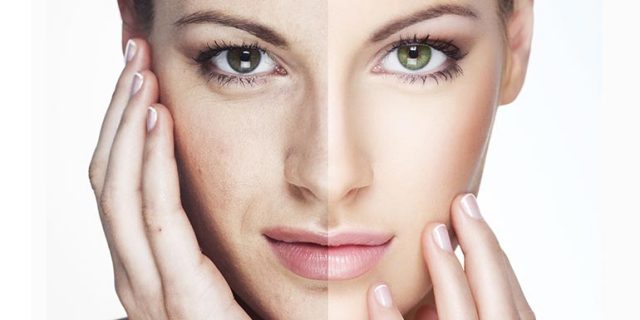nanograft-nanofat-piel-ojeras-madrid Nanograft Nanofat piel y ojeras Madrid. Tratamiento células madre