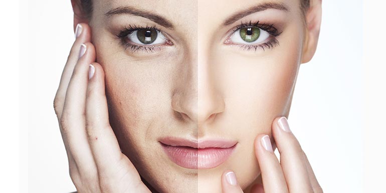 nanograft-nanofat-piel-ojeras-madrid Nanograft Nanofat piel y ojeras Madrid. Tratamiento células madre