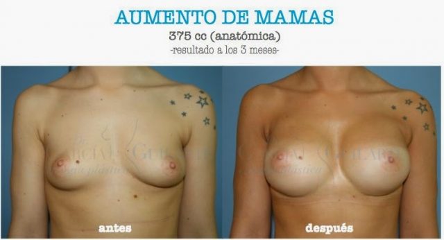 AUMENTO-DE-MAMAS.085