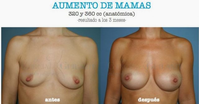 AUMENTO-DE-MAMAS.1001