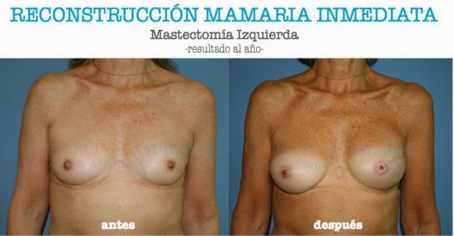 RECONSTRUCCION-MAMA.0031