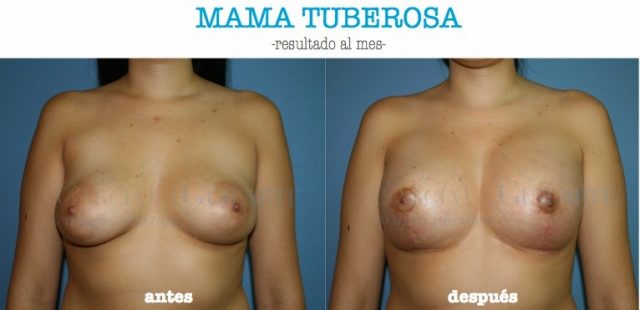 mama_tuberosa_cicatriz_vertical2