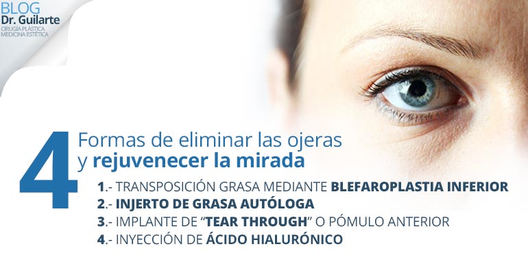 4-formas-de-eliminar-ojeras-y-rejuvenecer-mirada-acido-hialuronico-blefaroplastia 4 formas de eliminar ojeras y rejuvenecer mirada acido hialuronico blefaroplastia