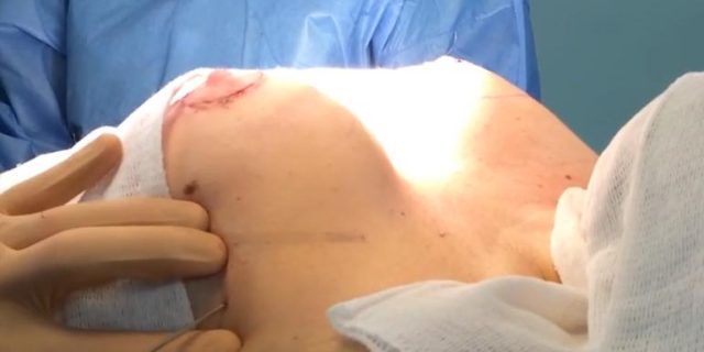 Lipofilling en mastopexia, vídeo didáctico de la operación de cirugía estética